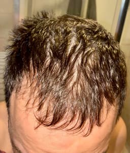 Doctor Aidee Doctor Aidee Vegan LPT Treatment — photo from Paul's review